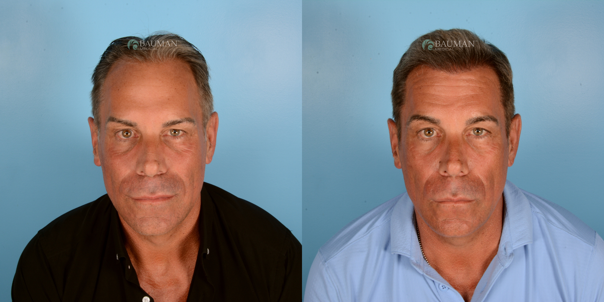 Hair Transplant Before and After Results