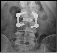 TLIF IdentiTi-PC Porous Titanium Interbody Implant System