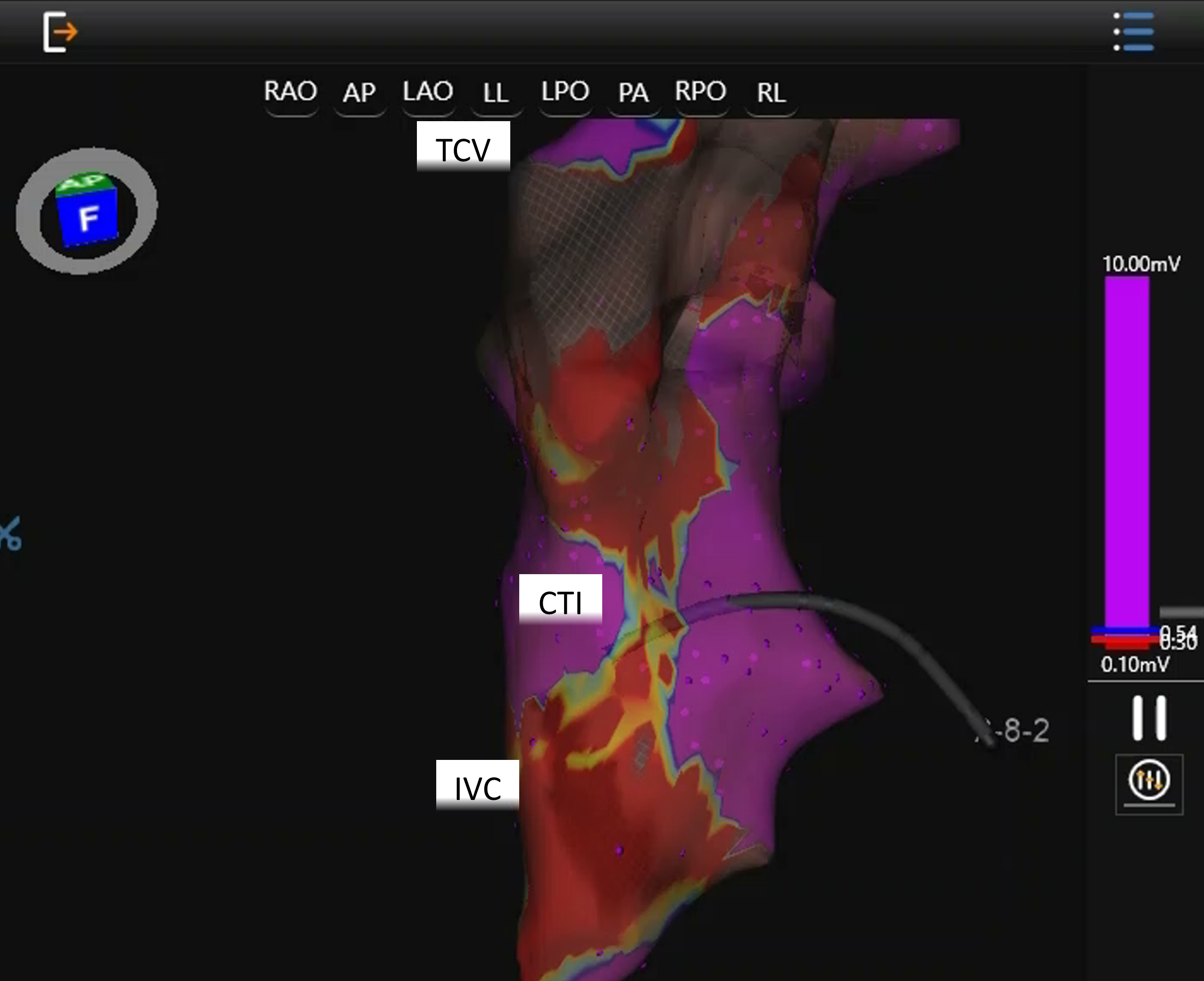 Voltage Map following Pulsed Field Ablation