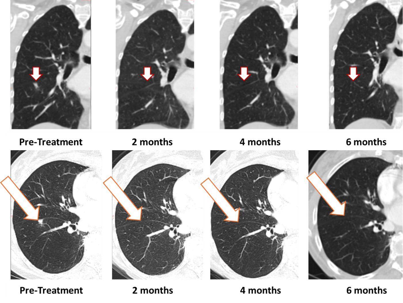 BriaCell Patient Achieves Sustained Complete Resolution of Lung Metastasis in Bria-OTS™ Metastatic Breast Cancer Study