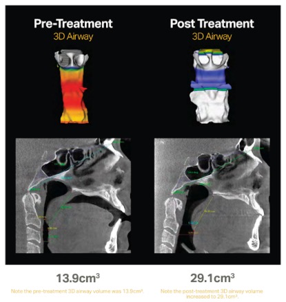 With a widened airway and easier breathing, the symptoms of sleep-disordered breathing often fade, and patients lead a more productive life. Shown, upper airway, pre- and post-treatment with the Vivos System. Dentists are uniquely qualified to apply the Vivos System, a non-invasive, non-surgical, non-pharmaceutical, multidisciplinary treatment modality for mild to moderate obstructive sleep apnea (OSA) that does not require lifetime care for most patients. Benco Dental will collaborate with Vivos Therapeutics, Inc. to help make all dentists in the United States aware of the company's unique apnea treatment.