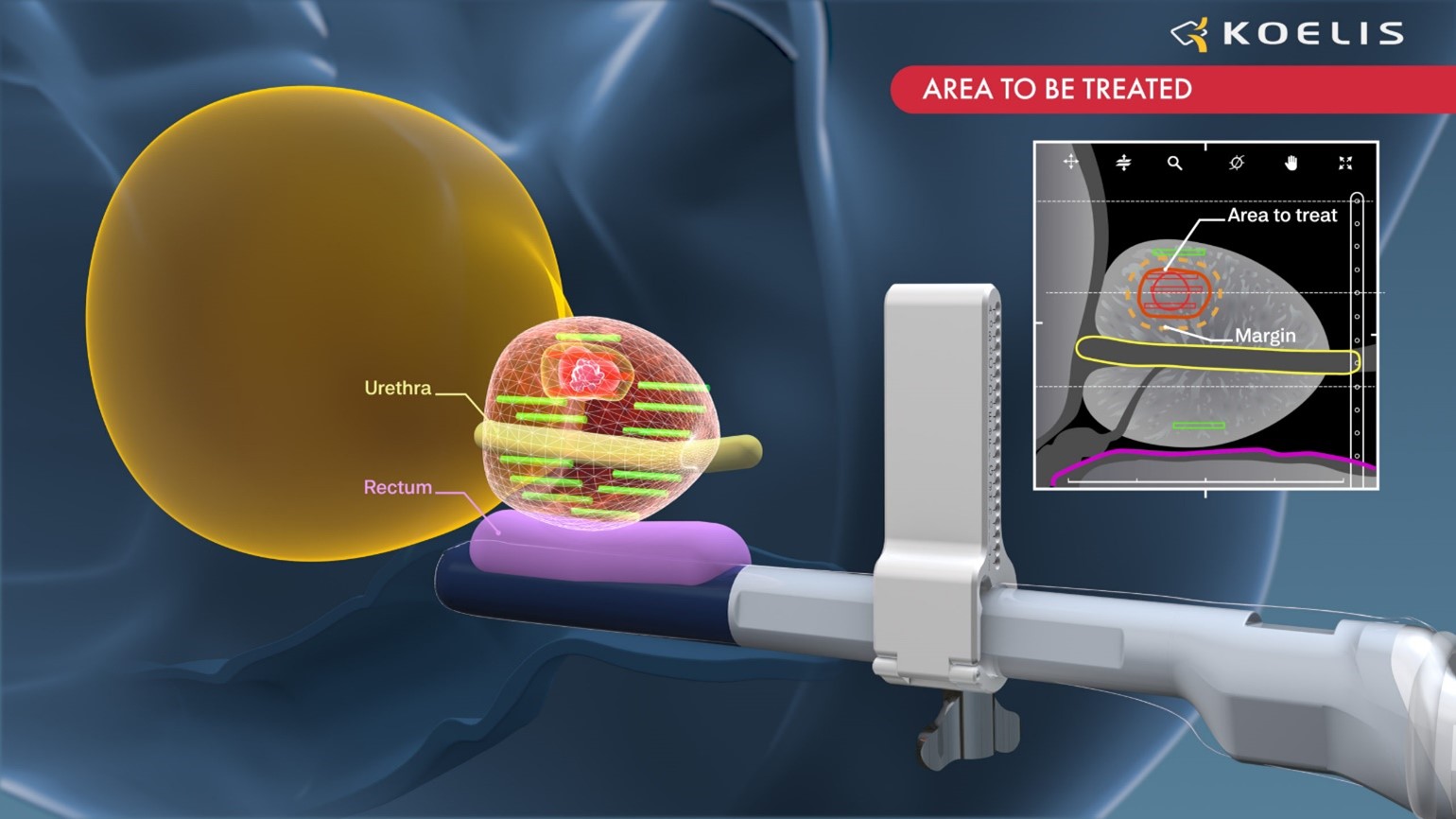 ProMap-FT met en œuvre la technologie exclusive d'imagerie 3D de Koelis pour permettre un guidage précis de la cryoablation et d'autres traitements focaux de la prostate.