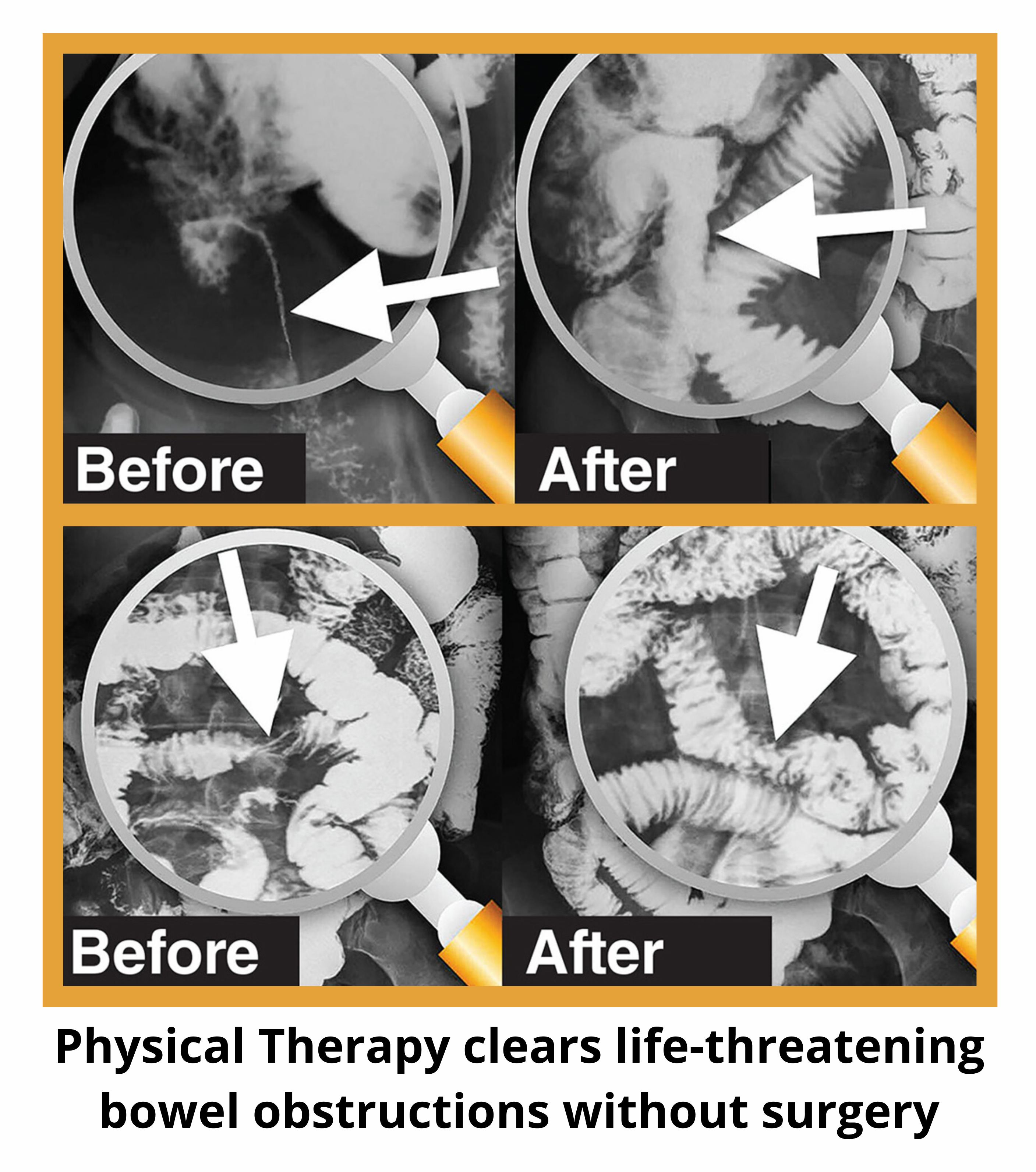 Before and after films of the intestines show that a unique, hands-on physical therapy cleared life-threatening bowel obstructions, eliminating the need for surgery.