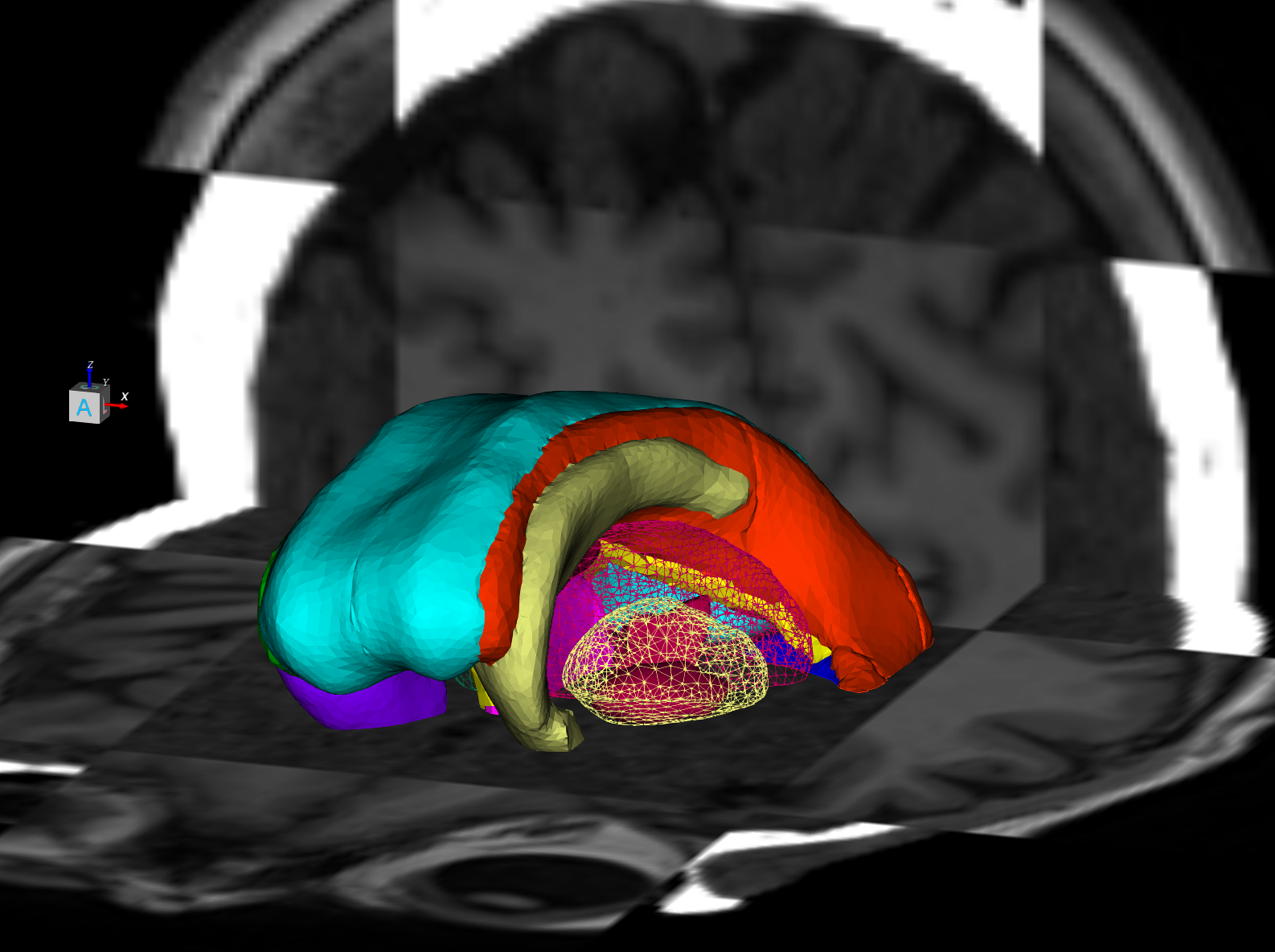 ClearPoint Neuro Maestro Brain Model Fully Automatic Subnuclei Segmentation for DBS