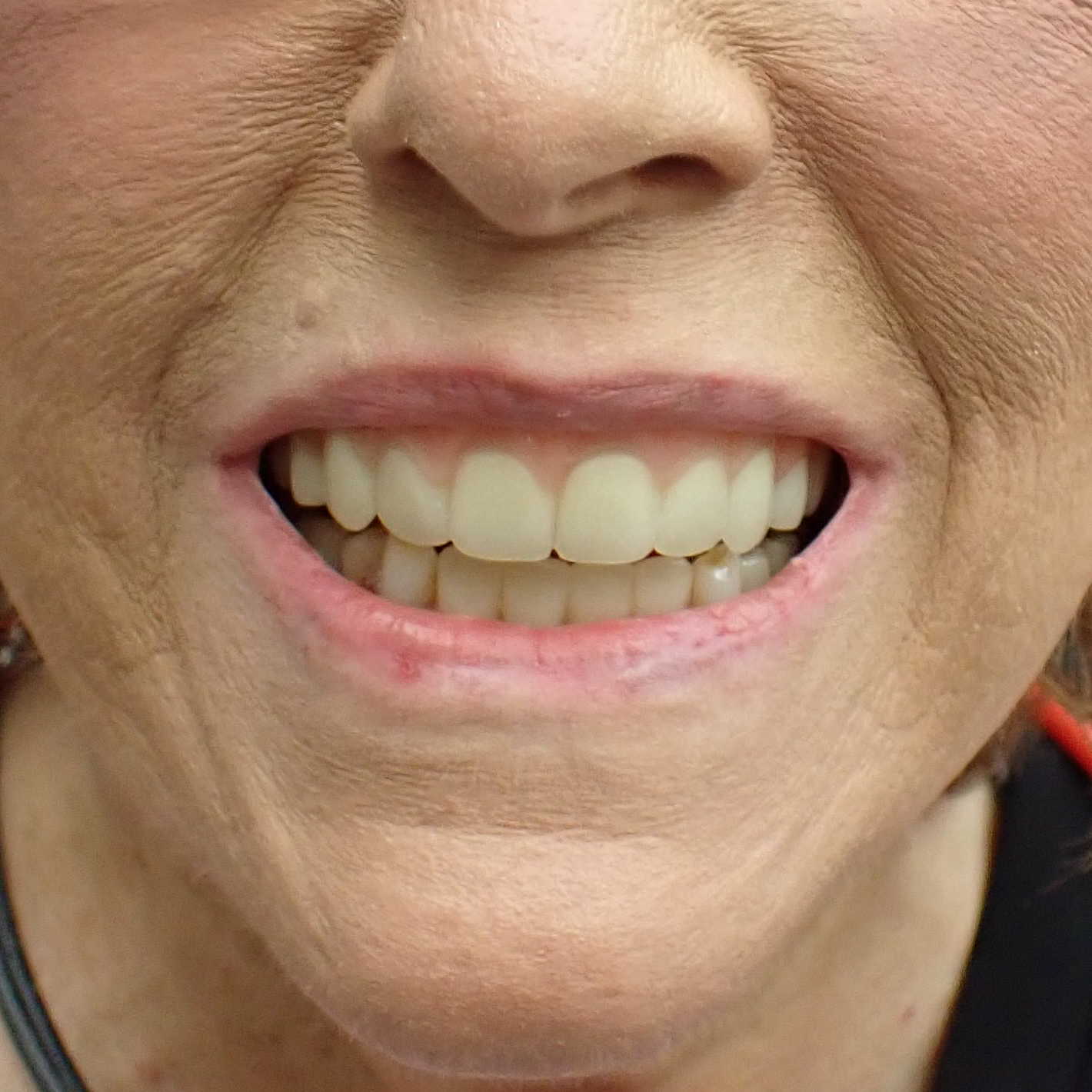 3d-systems-jetted-dentures-patient