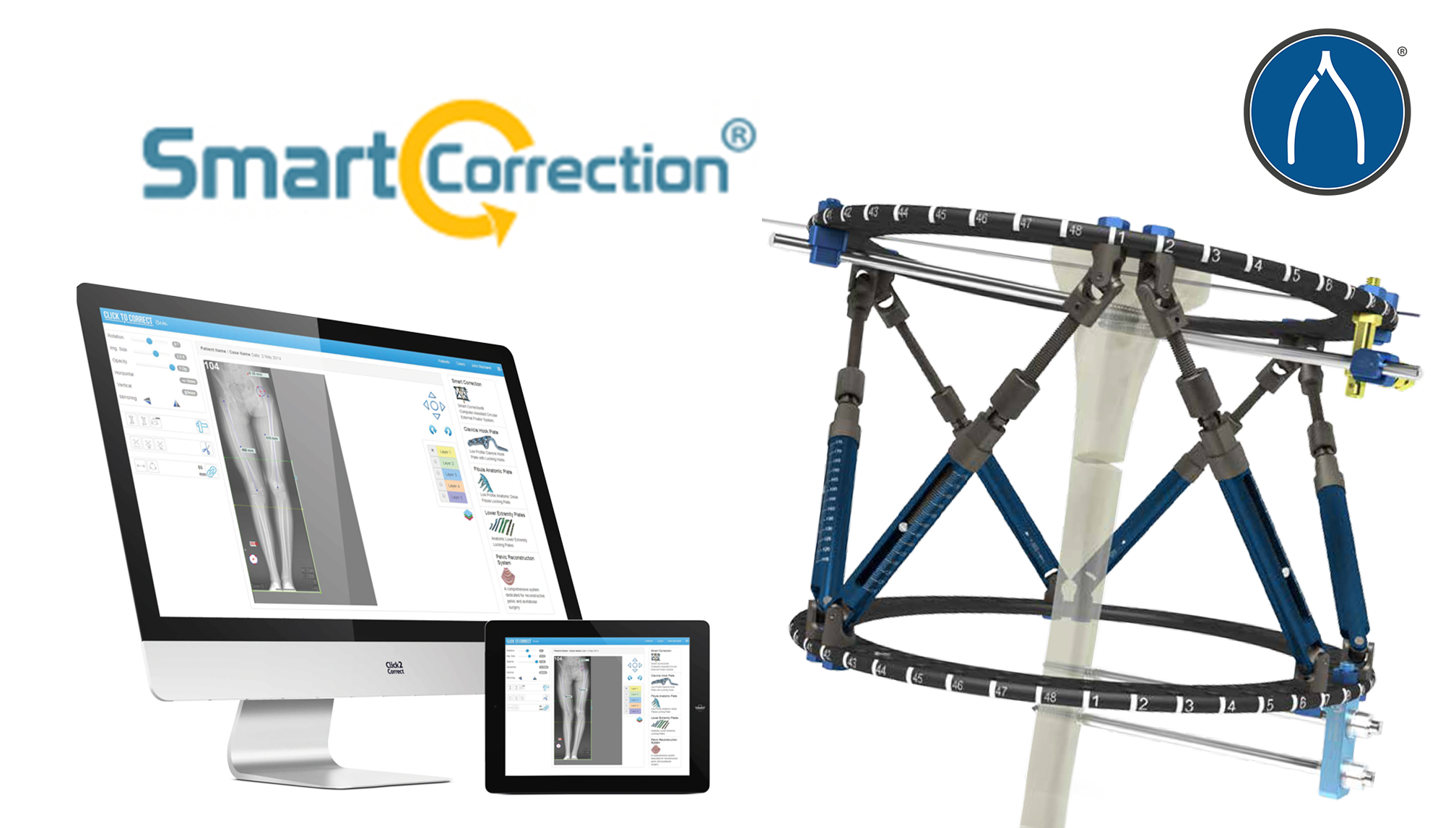 The WishBone Medical Smart Correction® System 