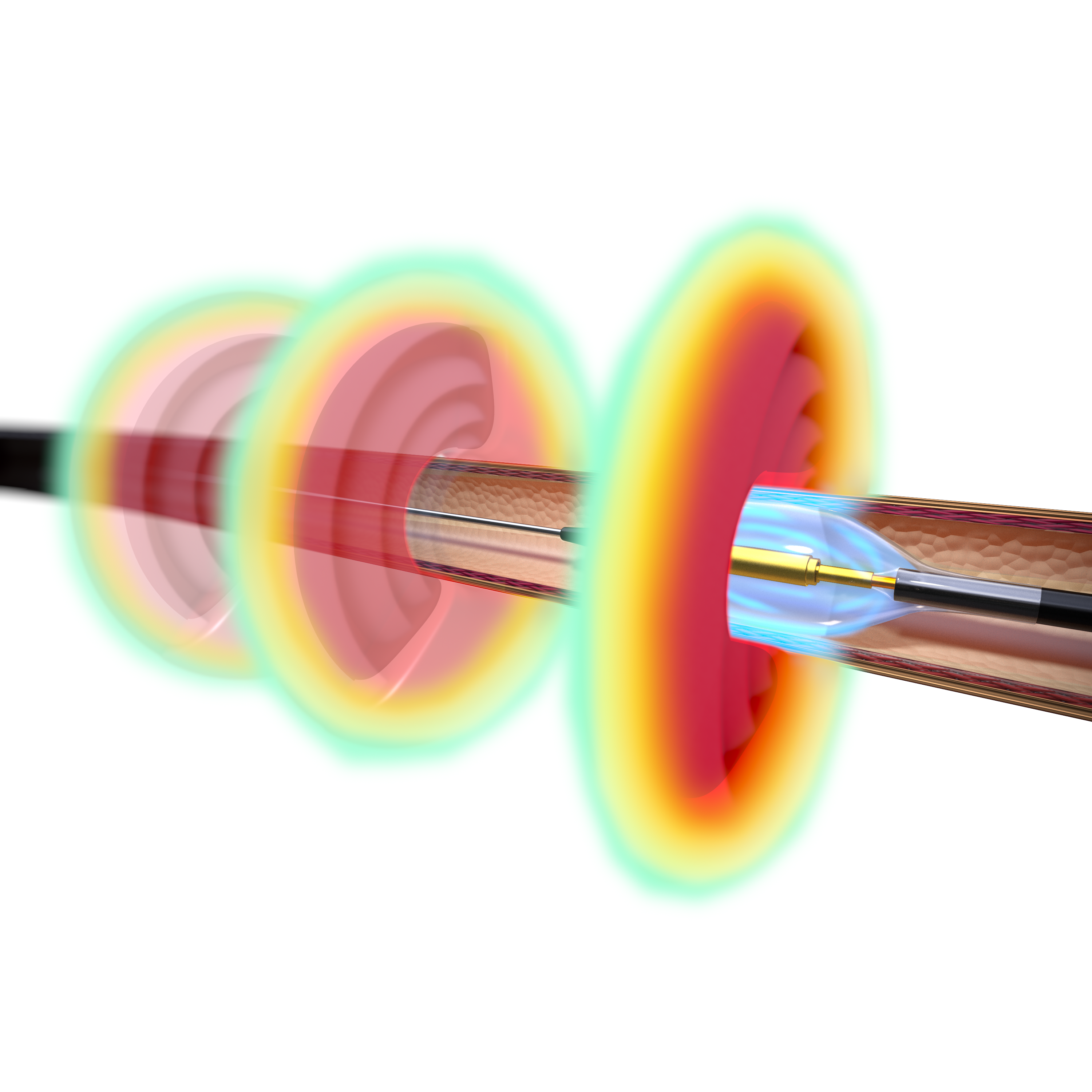 The Paradise uRDN system is a first-of-its-kind ultrasound-based renal denervation (RDN) technology designed to lower blood pressure by denervating overactive sympathetic nerves surrounding the renal arteries. Paradise uRDN delivers two to three doses of 360-degree ultrasound energy — lasting seven seconds each — through the main renal arteries to the surrounding nerves. The Paradise catheter features the exclusive HydroCooling™ system, which circulates sterile water through the balloon during the procedure to help cool and protect the inner layers of the renal artery.