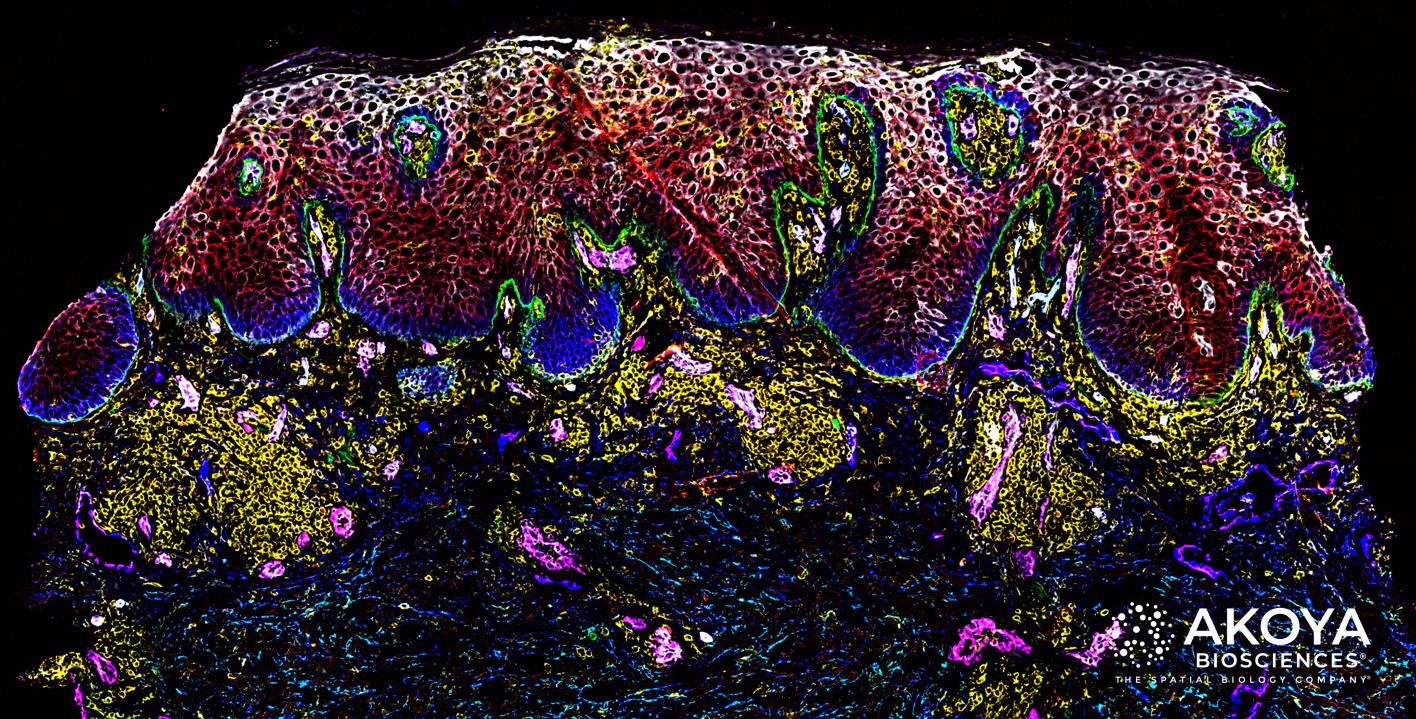 A human skin tissue sample shows the spatial interactions of immune cells and skin epidermal cells in a psoriasis rash. Immune cells (in yellow) are seen to cluster beneath the epidermis as part of the local immune response. The tissue was stained with a 23-marker CODEX® panel to visualize epithelial and vascular markers and to survey the immune landscape of skin inflammation related to psoriasis.