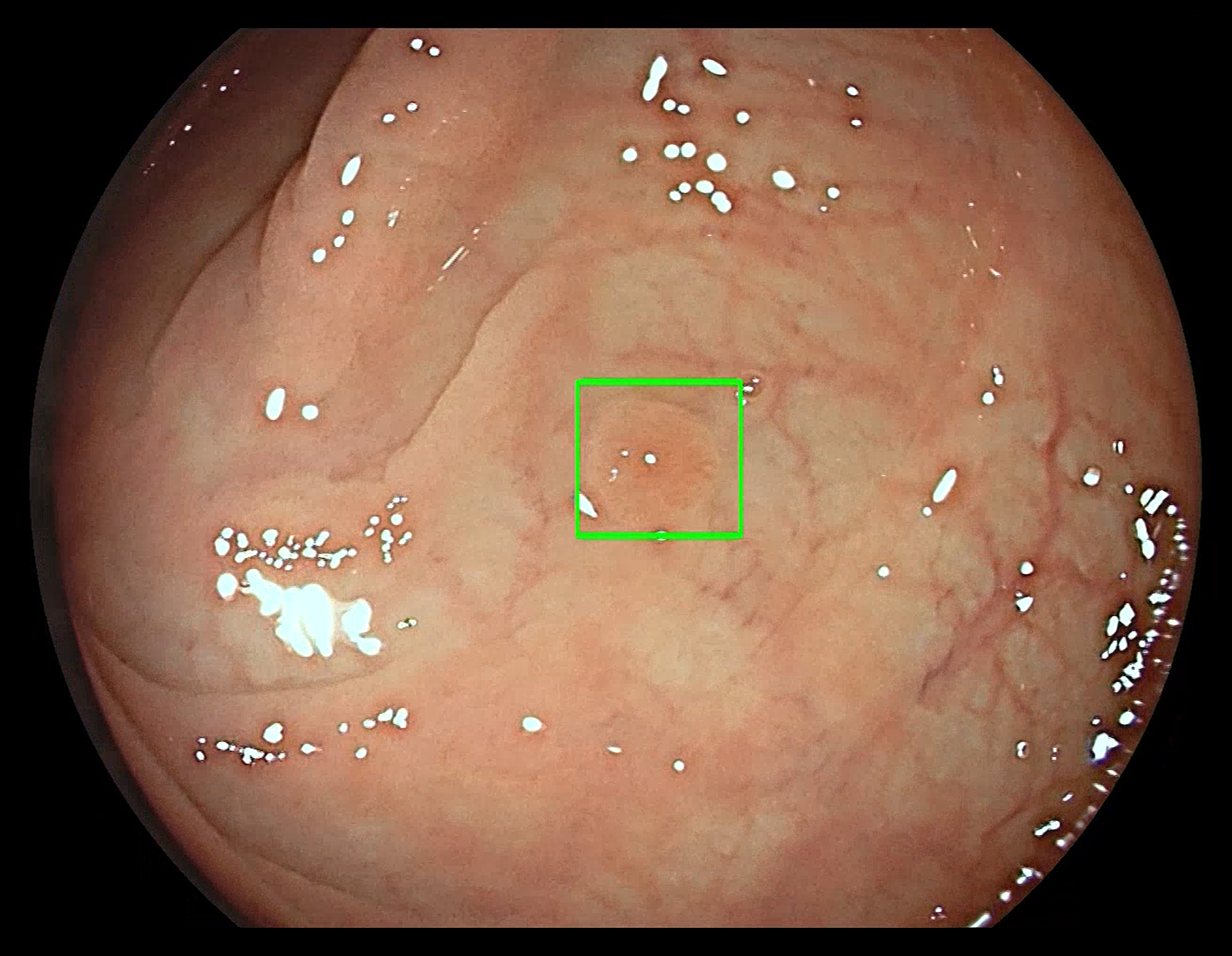 GI Genius™ Intelligent Endoscopy Module