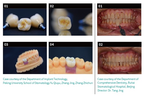 “dentitude Pro” Dual-Ion Reinforced Glass-Ceramic Awarded Guinness World Records™ Title