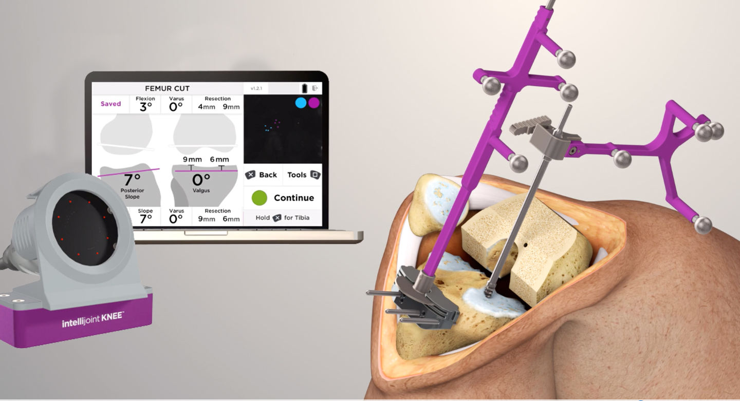 Intellijoint KNEE™ smart navigation provides real-time measurements of varus/valgus, flexion and slope angles, and resection depth to help surgeons accurately position their cutting guides during total knee arthroplasty. Kitchener, Canada, Thursday, February 20, 2020