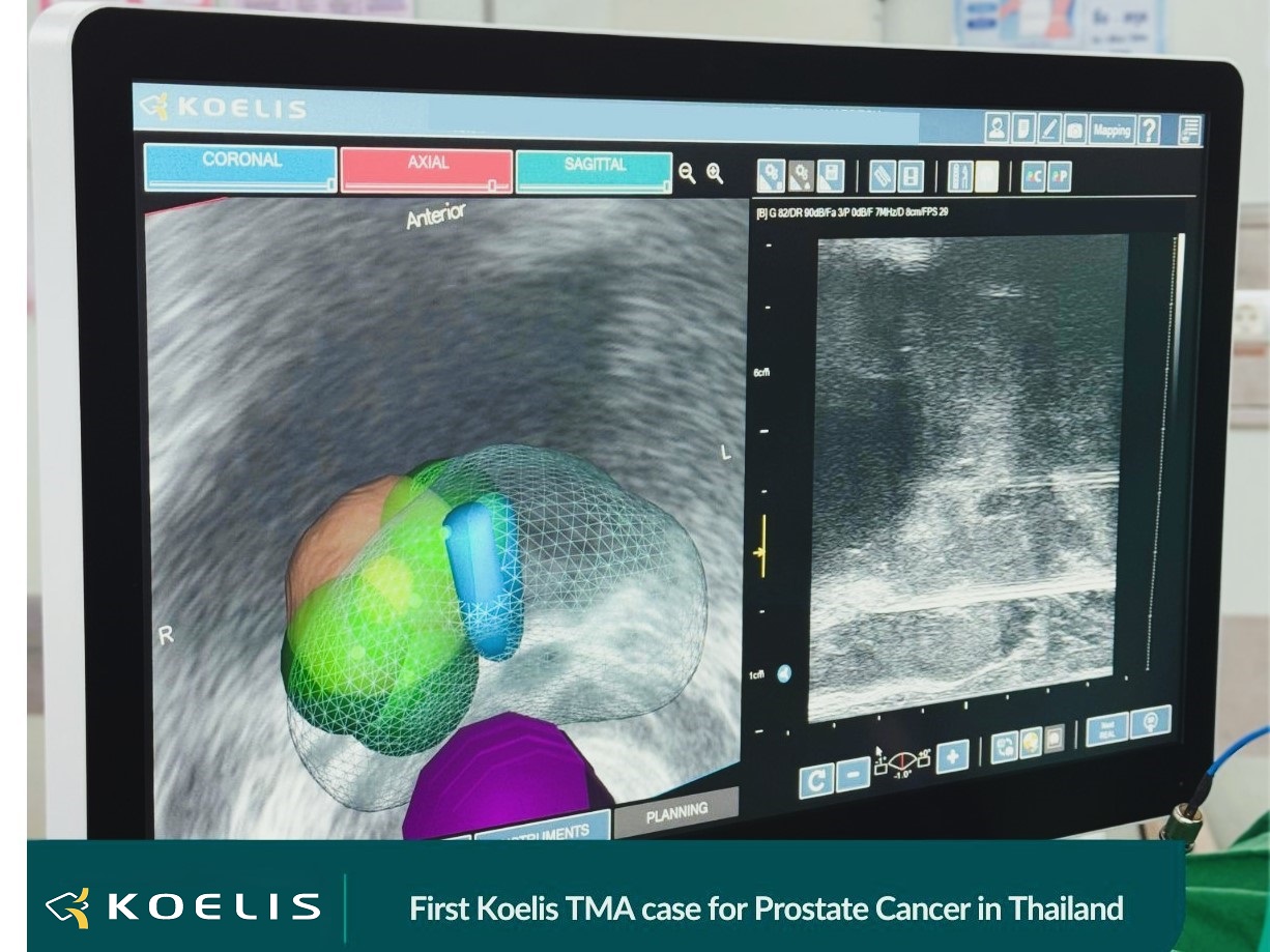 First Koelis TMA case for Prostate Cancer in Thailand