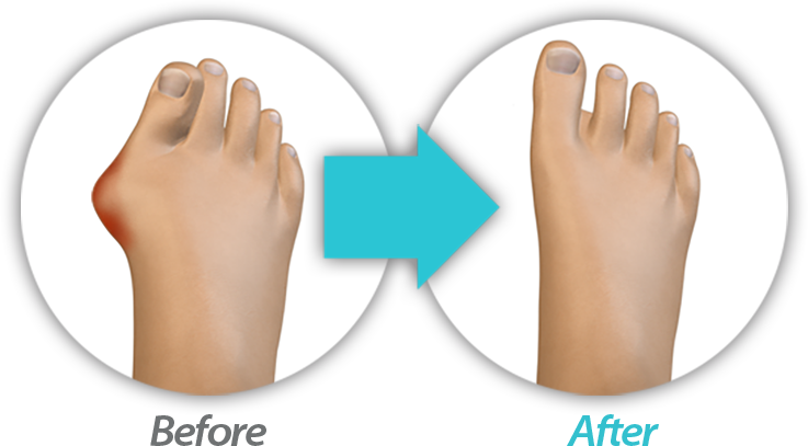 Before and After Bunion Surgery