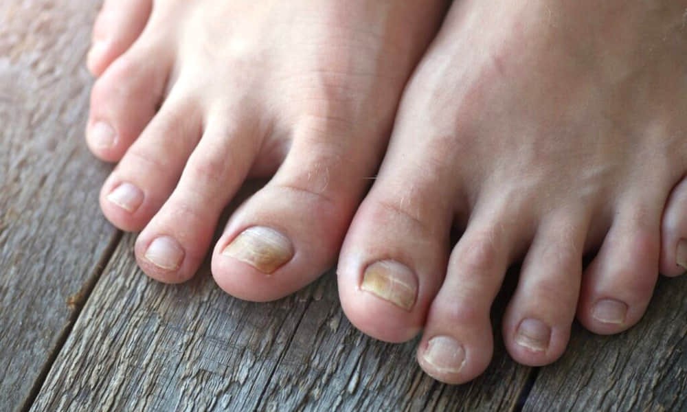The Problem with Toe Nail Fungus (Welnax Bioclear reviews)