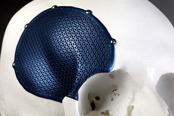 Materialise 3D printed CMF titanium implant