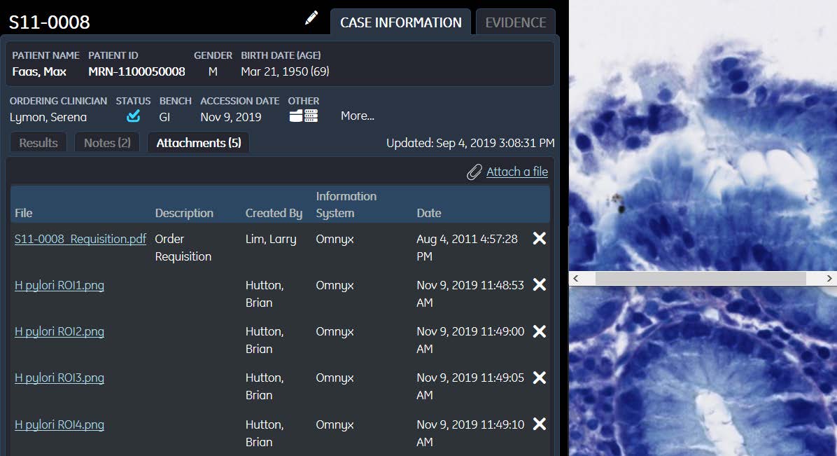 Areas suspected of containing Helicobacter Pylori are clearly marked by the DeePathology Decision Support System within Inspirata Dynamyx for review by the pathologist. 