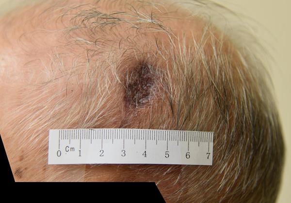 Patient A (Aged 93): 1 Week of Treatment