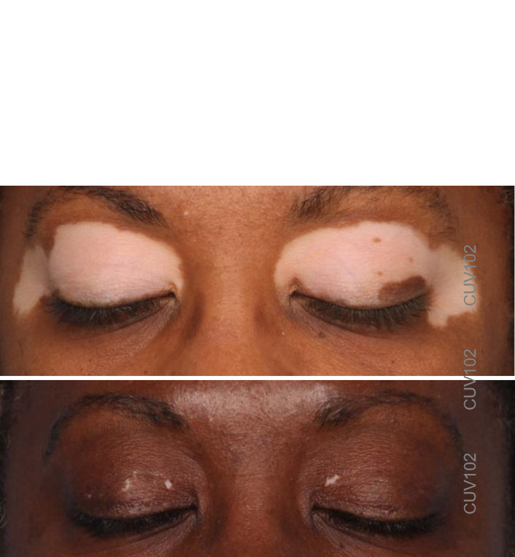 Vitiligo repigmentation in CUV102 study