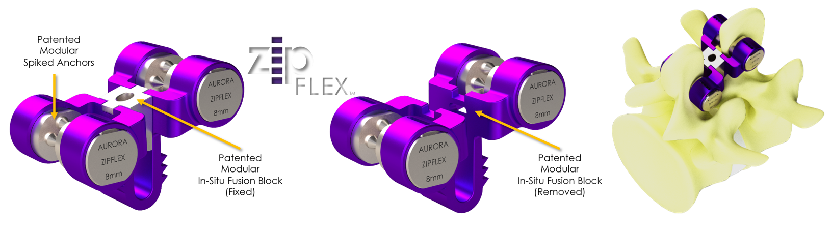 ZIPFlex™: Patented Modular In-Situ Fusion Block