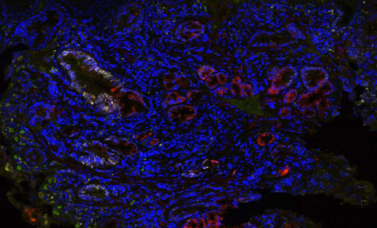 TissueCypher Sample Image

TissueCypher detected multiple high-risk features in this biopsy from a patient with short segment, non-dysplastic Barrett's esophagus, as confirmed by the GI subspecialist. TissueCypher scored this case High Risk for progression to HGD/EAC within five years. The patient was diagnosed with HGD on surveillance endoscopy 2.5 years later.