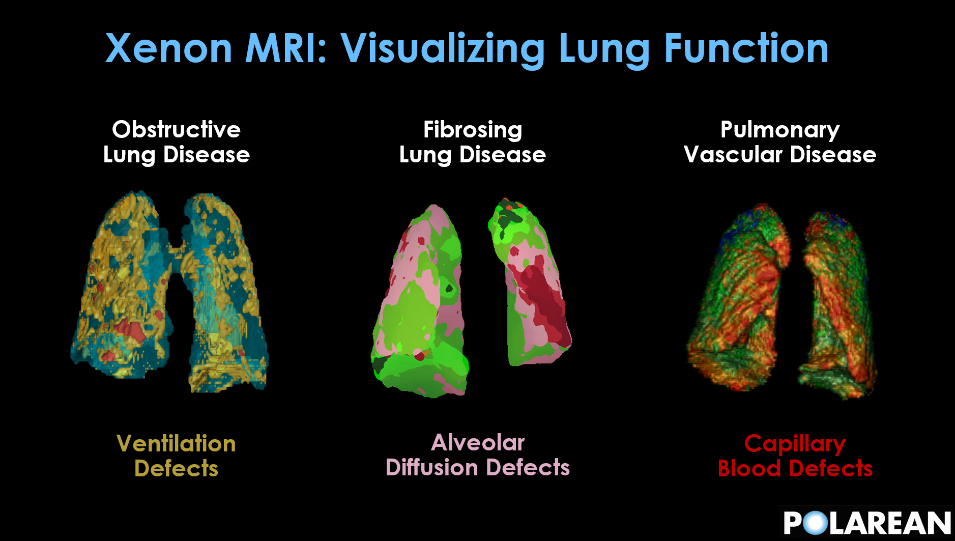 Xenon MRI continues to evolve into a practical cardiopulmonary biomarker platform for clinical trials and therapeutic development