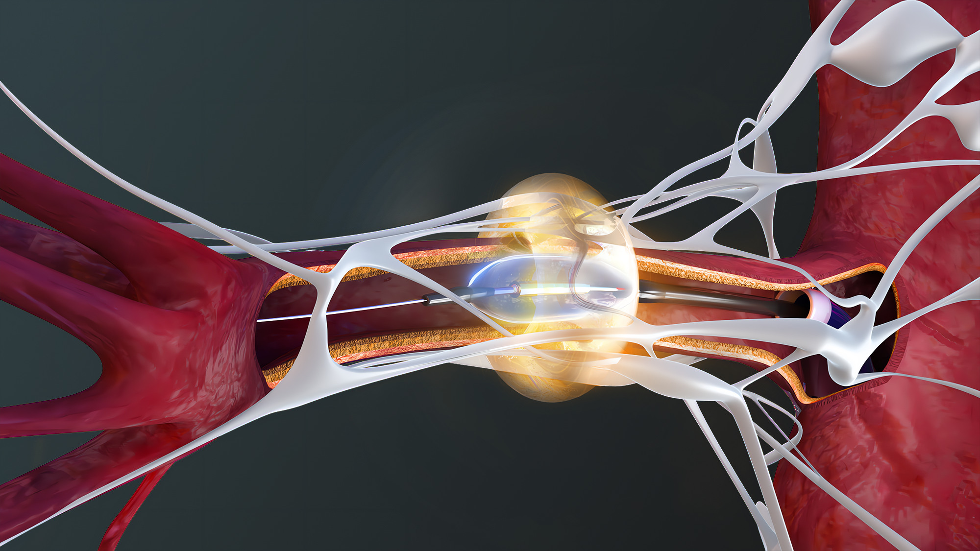 Paradise Ultrasound Renal Denervation System