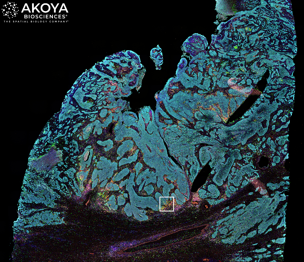 Akoya’s Phenoptics™ platform captures high resolution images of whole tumor sections from patients, enabling researchers to study the spatial biology of the sample – i.e., how tumor and immune cells interact within the tumor microenvironment and influence response to immunotherapy. Different colors represent different cell types and biomarkers. The white box represents a zoomed in area for deeper microscopic analysis.