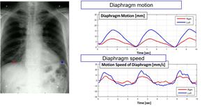 Dynamic Digital Radiography is an enhanced X-ray technology that enables clinicians to analyze and quantify the dynamic interaction of anatomical structures with physiological changes over time to enhance diagnostic capability and efficacy.