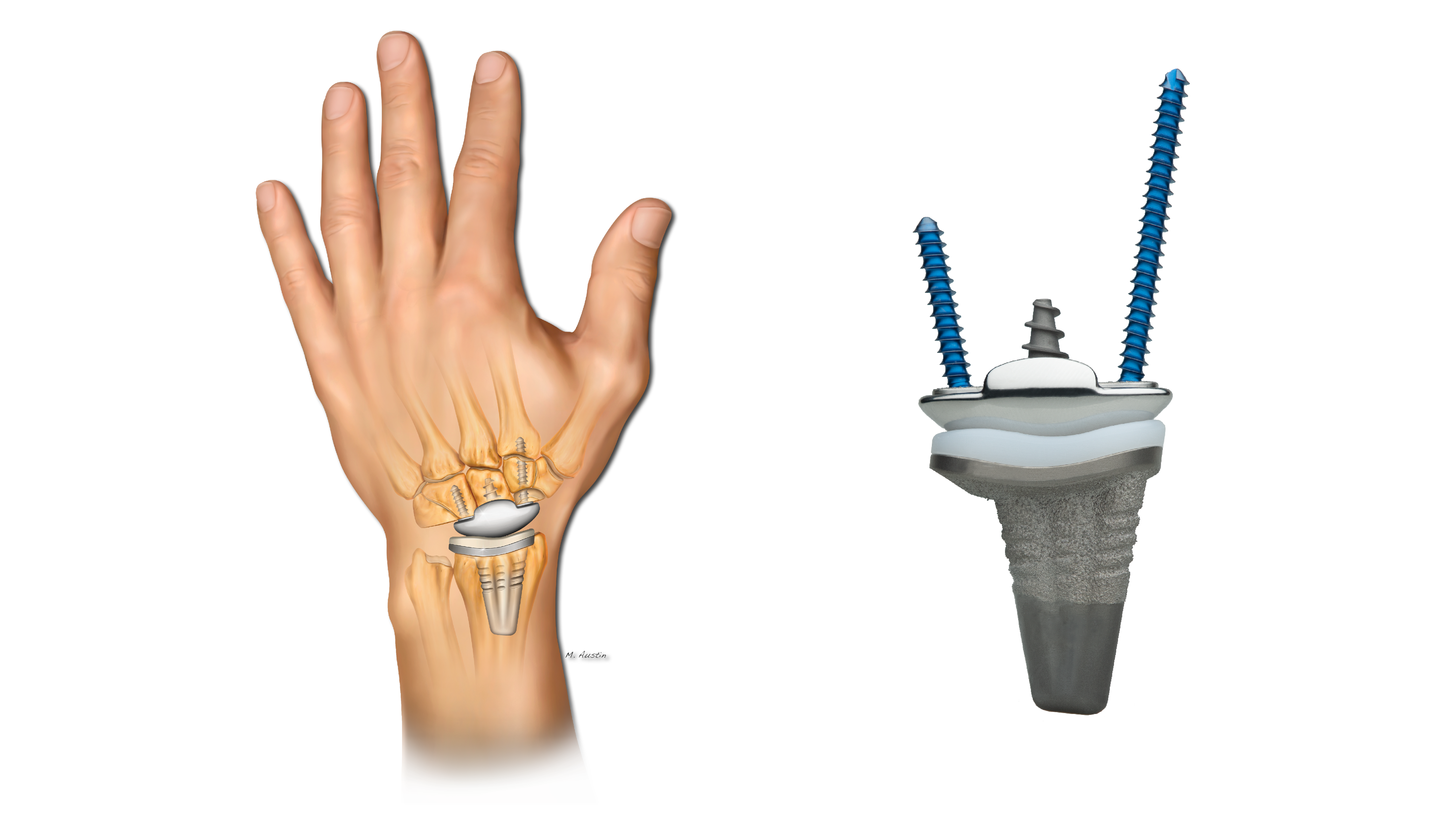 WristMotion Total Wrist Arthroplasty System illustration and implant construct