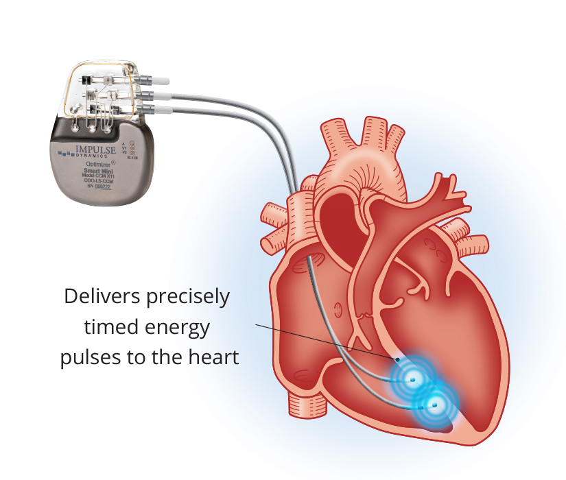 Optimizer Smart Mini Delivery System With Leads to the Heart