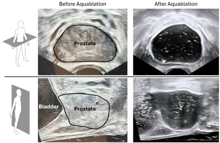 Figure: Aquablation Therapy for Prostate Cancer