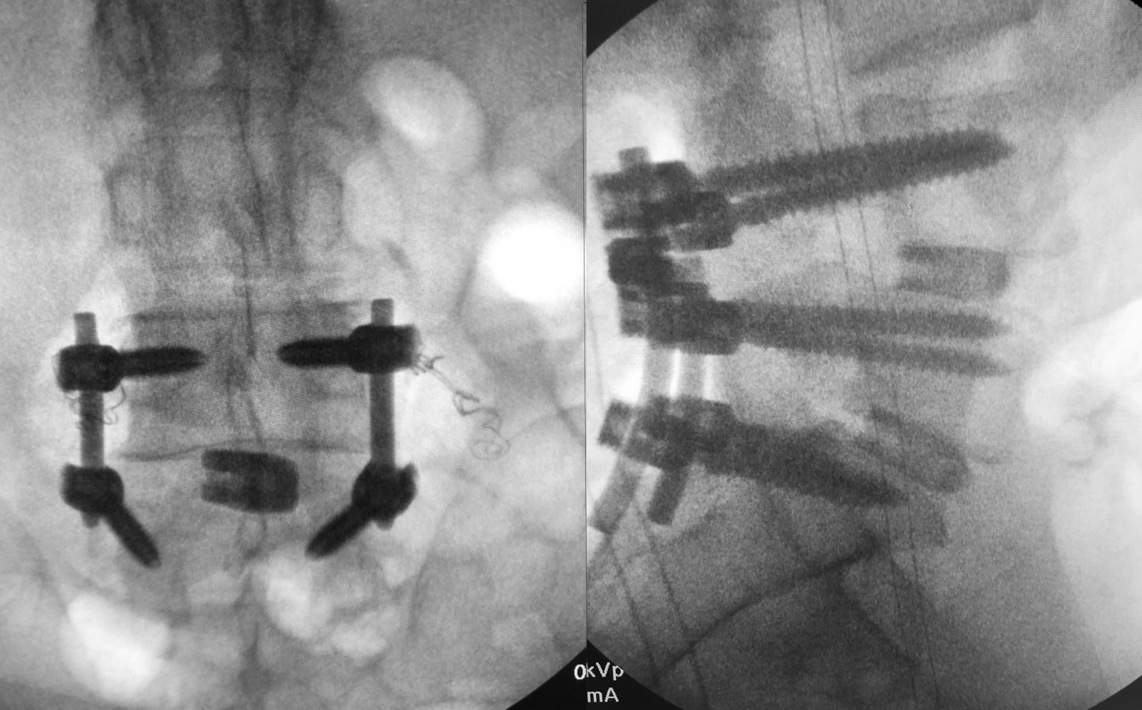 IdentiTi TLIF Posterior Oblique Porous Titanium Interbody