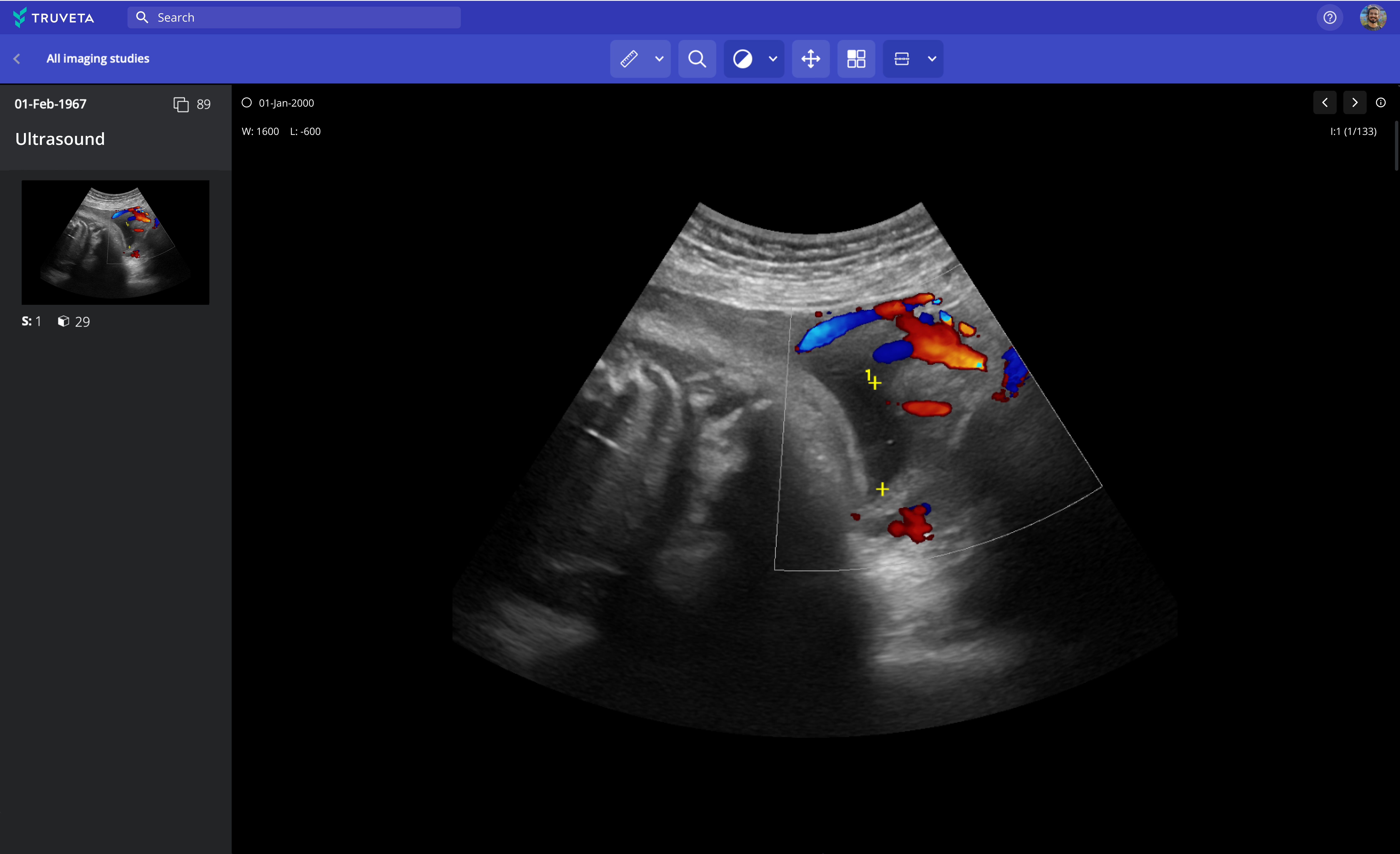 Truveta now empowers researchers to learn from millions of de-identified medical images – across all modalities, including MRI, CT, X-ray, ultrasound, mammogram, and nuclear medicine – integrated with the patient’s EHR data.