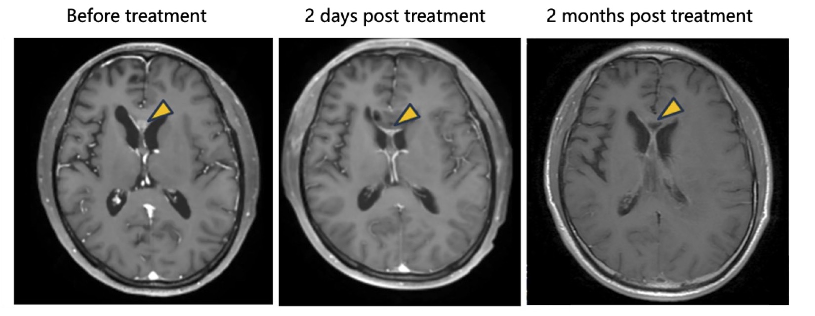 NeuExcell Therapeutics Reports Encouraging Clinical Results with World’s First In Situ Conversion Therapy for Malignant Glioma