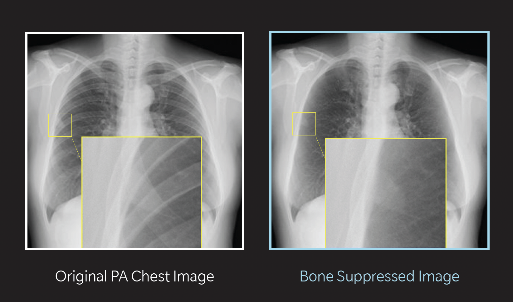 Bone Suppression Imaging from Konica Minolta suppresses the ribs and the clavicle from standard chest radiographs to enable clearer visualization of the lung and reveal soft-tissue details that may otherwise remain obscured.