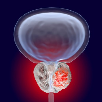 Artist interpretation of a growing prostate tumor.
