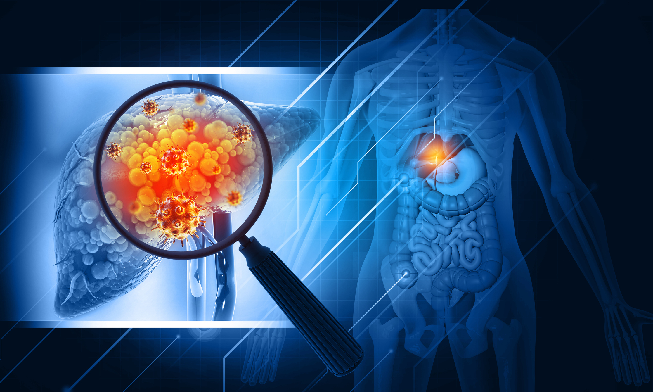 PRISM MarketView Spotlights Companies Leading the Charge in Liver Disease Treatment Following Landmark FDA Approval