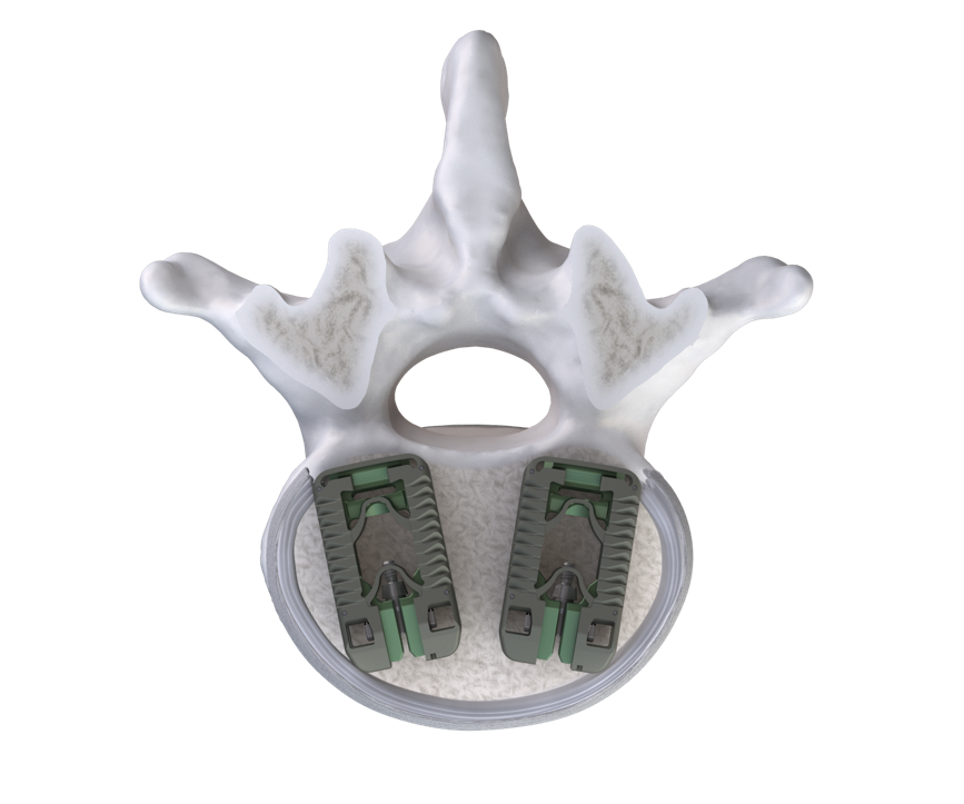 The FlareHawk TiHawk11 Interbody Fusion System features an 11mm-wide insertion profile that expands to 17mm in width within the disc space. This allows for two TiHawk11 devices to be implanted via a posterior approach to create a 34mm-wide footprint within the disc space.