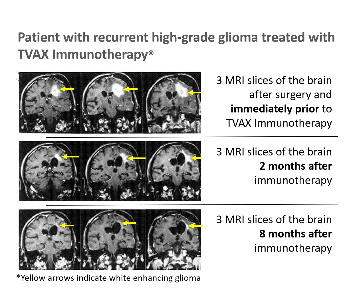 Patient with recurrent high-grade glioma treated with TVAX Immunotherapy