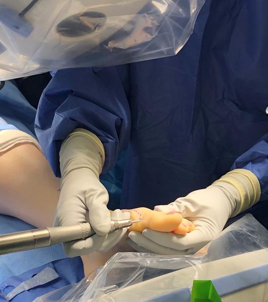 Minimally invasive surgery (MIS) is a technique used by foot and ankle orthopaedic surgeons to correct specific foot and ankle conditions with very small incisions.