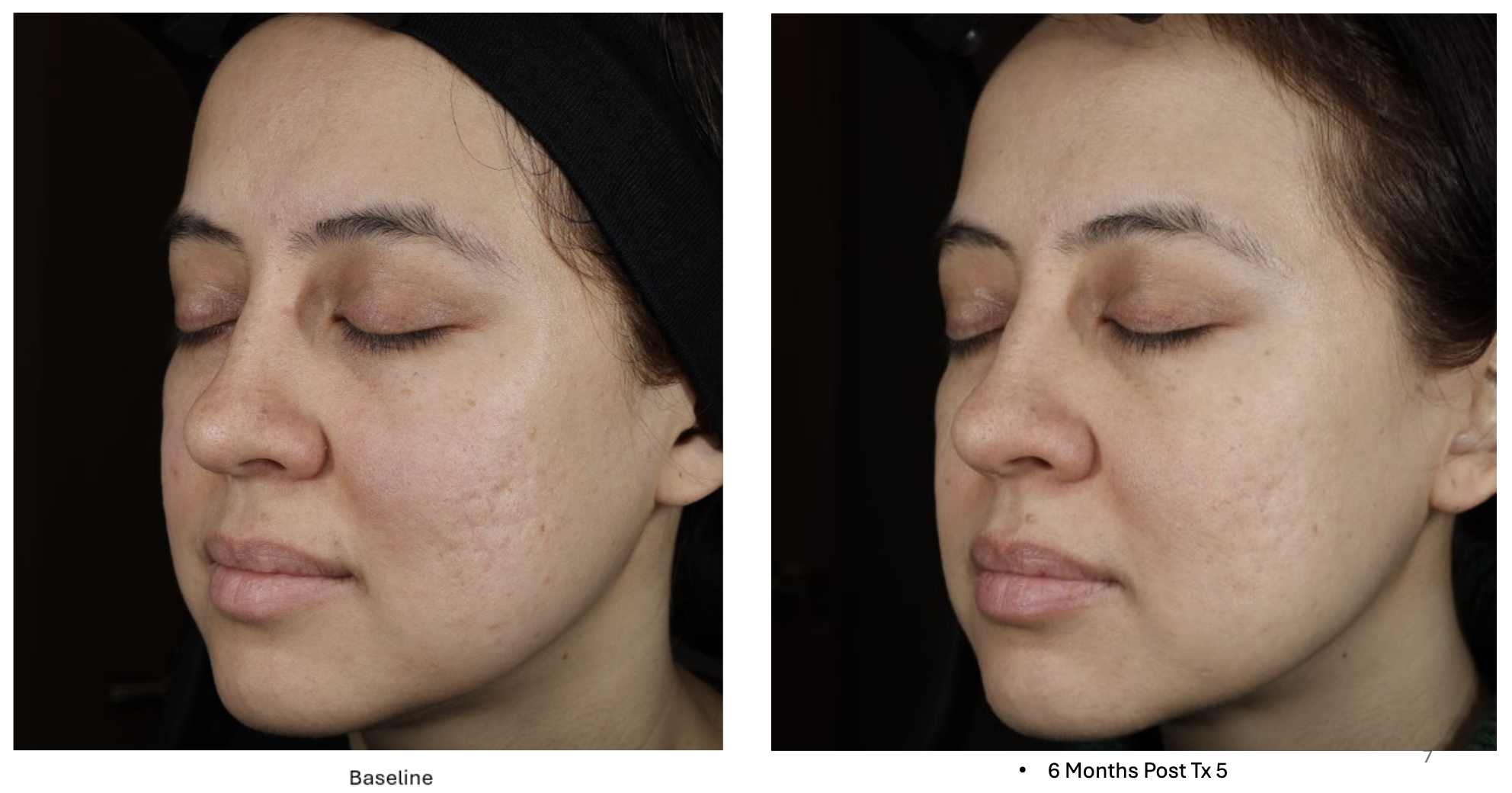 6 months post 5 treatments