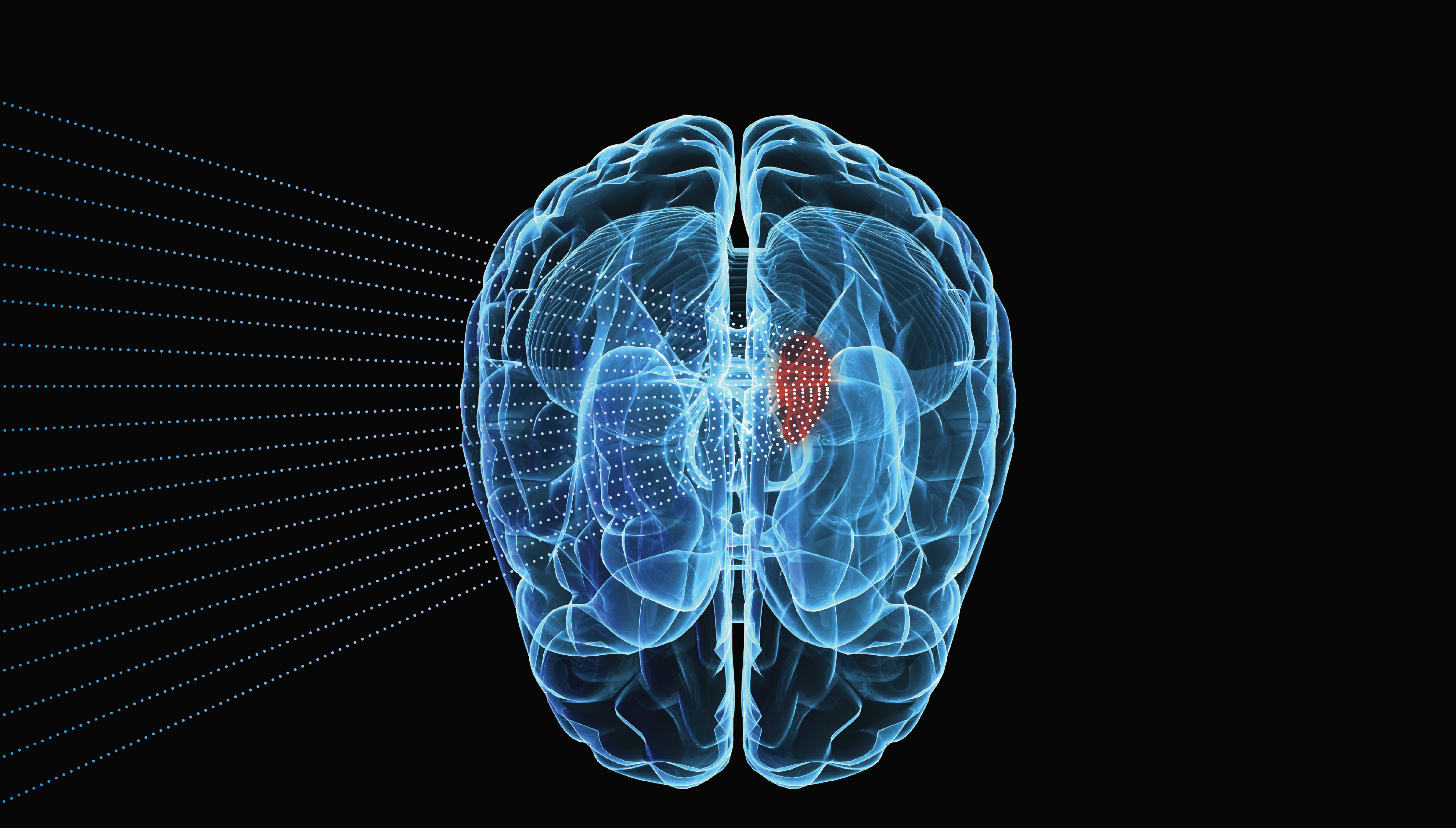 Ivy Center's clinical trial of sonodynamic therapy uses Insightec’s magnetic resonance-guided focused ultrasound (MRgFUS) technology in combination with SonALAsense’s proprietary intravenous formulation of 5-aminolevulinic acid (SONALA-001) to investigate the feasibility, safety, and biological effects of the treatment