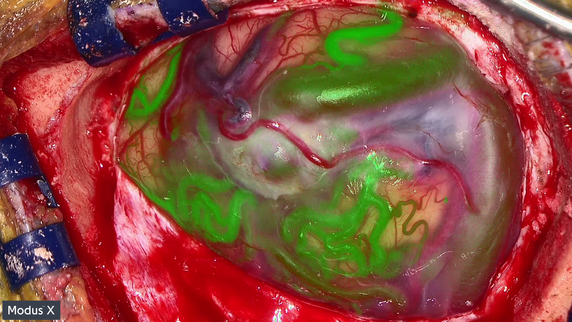 IR fusion for AVM using Synaptive's Modus X exoscope