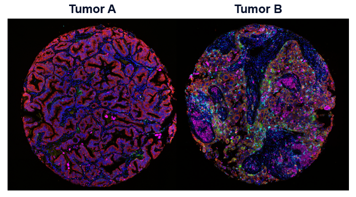 Lung cancer FFPE samples phenotyped using the PhenoCode Signature Immuno-Contexture Panel