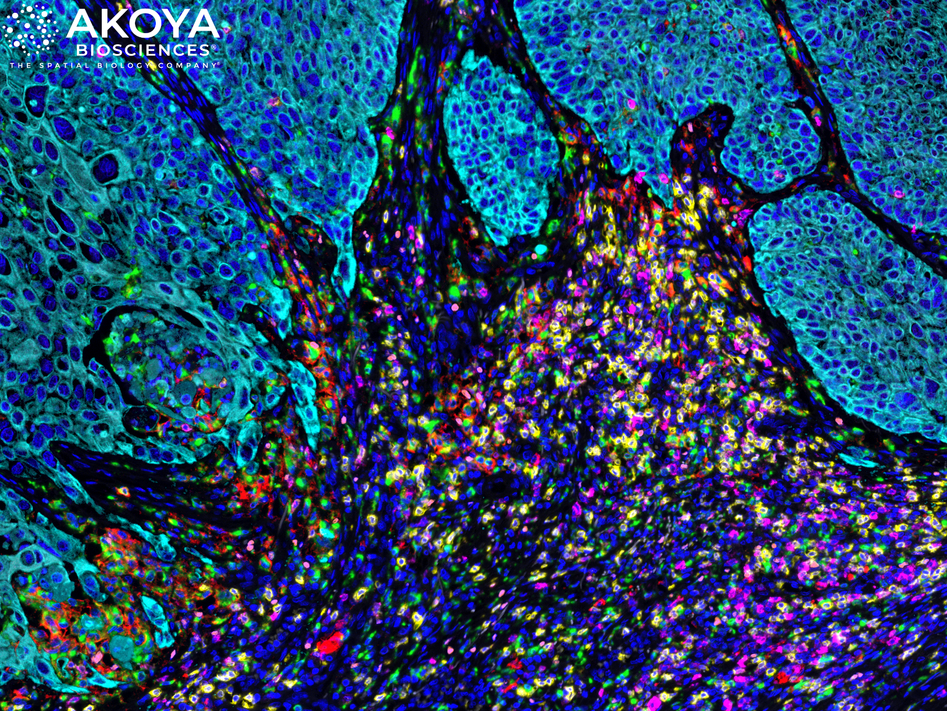 The zoomed in area from image 1 allows a deeper analysis of specified ‘hotspots’.  Different colors represent different cell types and biomarkers e.g., PD-1, PD-L1 (checkpoint targets in pink and red respectively), cytotoxic T cells (a type of immune cell, in yellow), regulatory T cells (in orange), macrophages (another type of immune cell, in green), and tumor cells (in cyan). The cellular composition and distribution reveals immune engagement with the tumor, evidenced by the immune cells (in yellow, green and orange) infiltrating the tumor areas (in cyan).