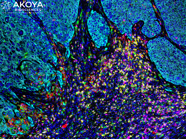 Image 3-Akoya Lung Cancer FFPE tissue-Zoomed In Phenoptics Image