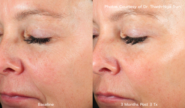 Wrinkle B&A - 3 Months Post 3 Tx