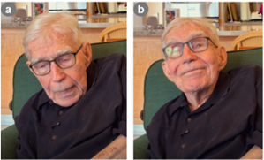 ALS patient demonstrating (a) lack of cervical muscular control prior to treatment, and (b) improved strength at 3 months of therapy. Note: Neck strength persisted at 6.5 months of therapy.