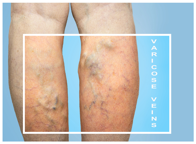 Vascular veins such as these may need to be treated by a vascular specialist, unlike spider veins, which typically don't results in serious problems. Vascular surgeons provide comprehensive care for veins and all vascular diseases. 

Credit: Marina113 / iStock / Getty Images Plus 