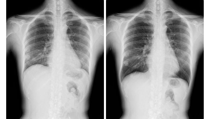Images from a DDR acquisition (visualization of anatomy in motion) of a patient breathing, demonstrating (left) inhalation and (right) exhalation.